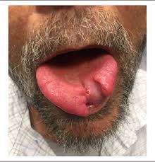 Image result for Tertiary Syphilis