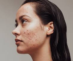 Effective Acne Treatment: Say Goodbye to Breakouts