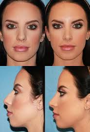Rhinoplasty Nose Job Nose Reshaping Photos San Diego La Jolla Nose Job Rhinoplasty Nose Jobs Nose Surgery Rhinoplasty