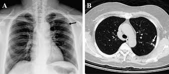 Nibib is funding research for development of a dedicated breast ct scanner that allows. Asymptomatic Pulmonary Nodules In A Patient With Early Stage Breast Cancer Cryptococcus Infection International Journal Of Infectious Diseases