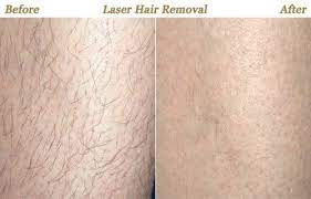 Hair remover by painless ipl laser hair removal from home laser portable mini hair removal laser. Laser Hair Removal Minneapolis St Paul Mn