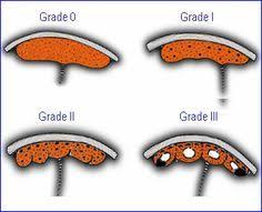 Placental Grades Medical Ultrasound Ultrasound Sonography Obstetric Ultrasound