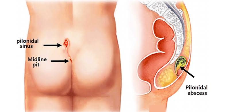 Pilonidal Sinus Laser Treatment