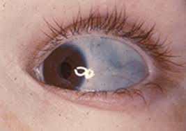 En revanche, le cancer des os secondaire est un type de cancer qui a écarté d'autres parties. Les Six Differences Entre Les Os De Verre Et Les Os Poreux 94 Des Femmes Auront Des Os Fragiles Protegez Vous