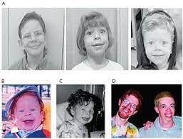 Williams Syndrome Wikipedia