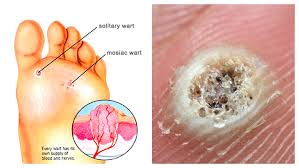 warts vascular health clinics