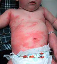 Actually, it is a reaction to these anaphylaxis causes a wide array of symptoms that include a rash, shock and, low pulse. Anaphylaxis Rash Workout Programs Exercise Anaphylaxis