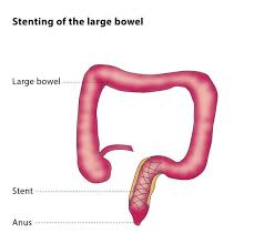 The intestine is also where most water is absorbed, via osmosis. Gastrointestinal And Oesophageal Stenting Cirse