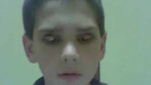 The conjunctiva can become exposed, red and irritated. How To Flip Your Eyelids Youtube