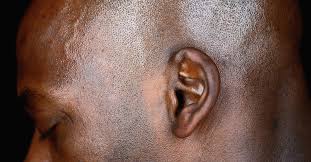 Meniere's disease linked to previous head trauma. Crackling In Ear Causes Symptoms Remedies Treatment