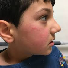 Image result for contact dermatitis