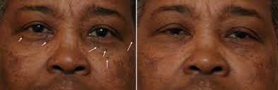 The most common pigment issues i see area post inflammatory hyperpigmentation, melasma, sun damage, and tattoos, sejal shah, a dermatologist. African American And Ethnic Skin Dermatology Black Dermatologist
