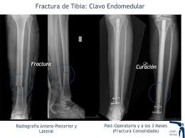 Fracturas En Traumatologia Deportiva Tratamiento Con Cirugia Y Tratamiento Conservador Juan Arnal Traumatologo En Madrid