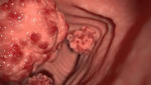 Image result for Colon Cancer Screening with Colonoscopy