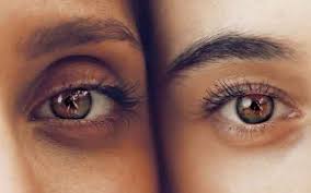 Selain dapat menghilangkan kantong mata, blepharoplasty juga dapat memperbaiki kelopak mata yang bengkak serta mengurangi kelebihan kulit kelopak mata bagian atas dan bawah. 17 Cara Menghilangkan Kantung Mata Secara Alami Dan Cepat June 2021