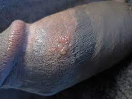 I remember sitting in excruciating pain in a room in the er, in front of a nurse and an ob/gyn, trying not to ugly cry. Core Concepts Herpes Simplex Virus Genital Pathogen Based Diseases National Std Curriculum