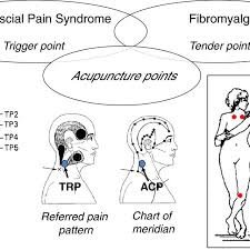 Close Relationships Among Trigger Points Acupuncture Points And Download Scientific Diagram