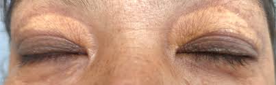 Image result for xanthelasma of eyelid