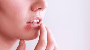 Image result for oral herpes symptoms roof of the mouth