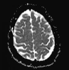 Autism spectrum disorder (asd) is complicated. Fmri Study Shows Different Patterns In Autistic Brains Imaging Technology News