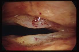 Image result for Chronic Laryngitis