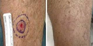It is uncommon for skin cancers to develop on the lower leg or for chronic ulcers to become malignant. Skin Cancer Treatment Tucson Skin Cancer Screening Arizona