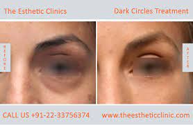 Dark Circle Treatment Mumbai Under Eye Dark Circle Removal Cost India The Esthetic Clinics