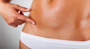 If the tummy tuck involves tightening the abdominal muscles, full healing can take several months. 6 Things You Should Do For Your Tummy Tuck Scars And Treatment