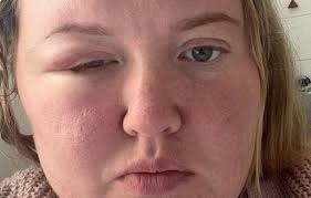 My week-long headache turned out to be a brain tumour'