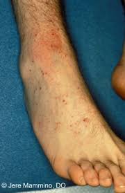Initial signs and symptoms of rocky mountain spotted fever often are. Rocky Mountain Spotted Fever American Osteopathic College Of Dermatology Aocd