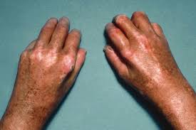 Image result for Systemic Sclerosis