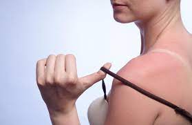 Its time depends on the severity of the sunburn, from 3 days to maybe more than seven days. How Long Does A Sunburn Last Lovetoknow