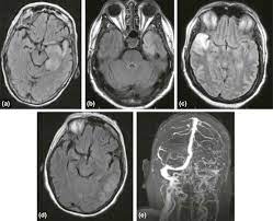 Encephalitis is an uncommon but serious condition in which the brain becomes inflamed (swollen). A Simplified Approach To Encephalitis And Its Mimics Academic Radiology