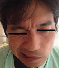 Facial nerve palsy in a patient with Guillain-Barré syndrome (GBS). A...