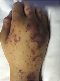 Your comments on videos will be key as we. Purpura Fulminans In Acute Meningococcemia Springerlink