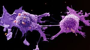 This case was discussed due to its rare. How Quickly Do Tumours Grow Cancer Research Uk Cancer News