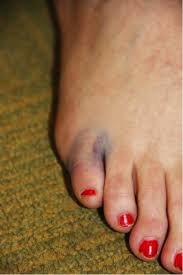 See full list on mayoclinic.org How To Know If You Have A Broken Toe Vargas Foot Ankle Specialists