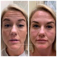 Before and After Botox to the forehead, by our nurse injector,  @shannon_woodnp This patient can still raise their eyebrows but look at  that smooth forehead! She loves her results so much! Amazing!