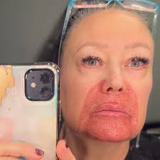 ✨24 Hours Update with Plasma Fibroblasting✨ Today is feeling Very Tight & a  little tingly, which is a combination of the healing & cellular activity ..  some inflammation & coloring is darker/pinker,