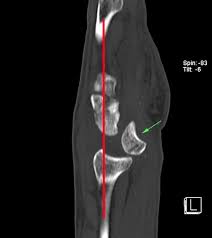 Image result for Lunate Dislocation