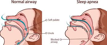 Image result for Sleep Apnea
