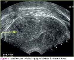 Harald krentel, generalsekretär der europäischen endometriose adenomyose ist eine sonderform der endometriose und entsteht, wenn gebärmutterschleimhaut in. Figure 6 From L Echographie Peut Elle Faire Le Diagnostic D Adenomyose Semantic Scholar