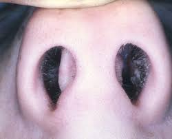 Check spelling or type a new query. Nasal Septum Surgery Ent Consultant Ent Surgery London Essex