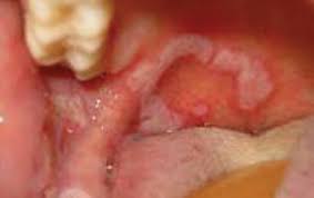 Image result for syphilis ulcer