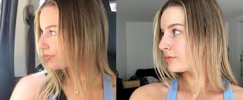 I Got a Liquid Nose Job: See Before and After Photos