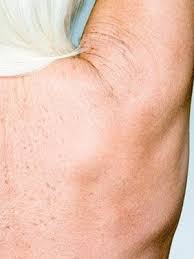 Breakthrough red light device that heals cold sores in 2 days. Cyst On Shoulder Skin Cysts Lumps Bumps Everyday Health