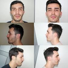 Whatsapp For English 00905337081616 Mr Batuhan Has Completed His Post Operative First Year The Front Of The Nose Before The S