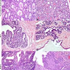 Cancer in cats is less common than cancer in dogs. Histopathology Of Normal Mammary Gland Uh Adh In Woman And Cat Download Scientific Diagram