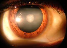 In extracapsular cataract surgery, your ophthalmologist makes a larger opening in the eye. Cataract Wikipedia