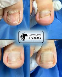 Image result for Onychotillomania feet
